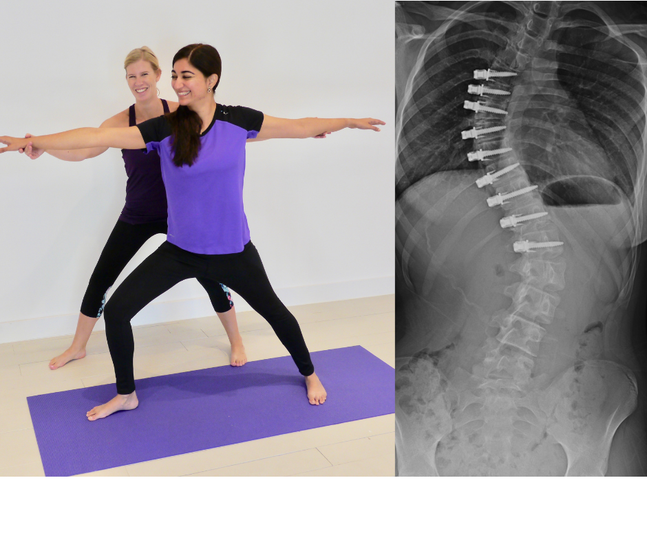 Best & worst sleeping positions for scoliosis - Yogaberry